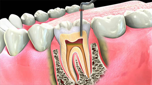 Root Canals - tuberose.com