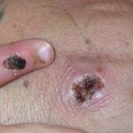 Mpox causes lesions that resemble pus-filled blisters, which eventually scab over.