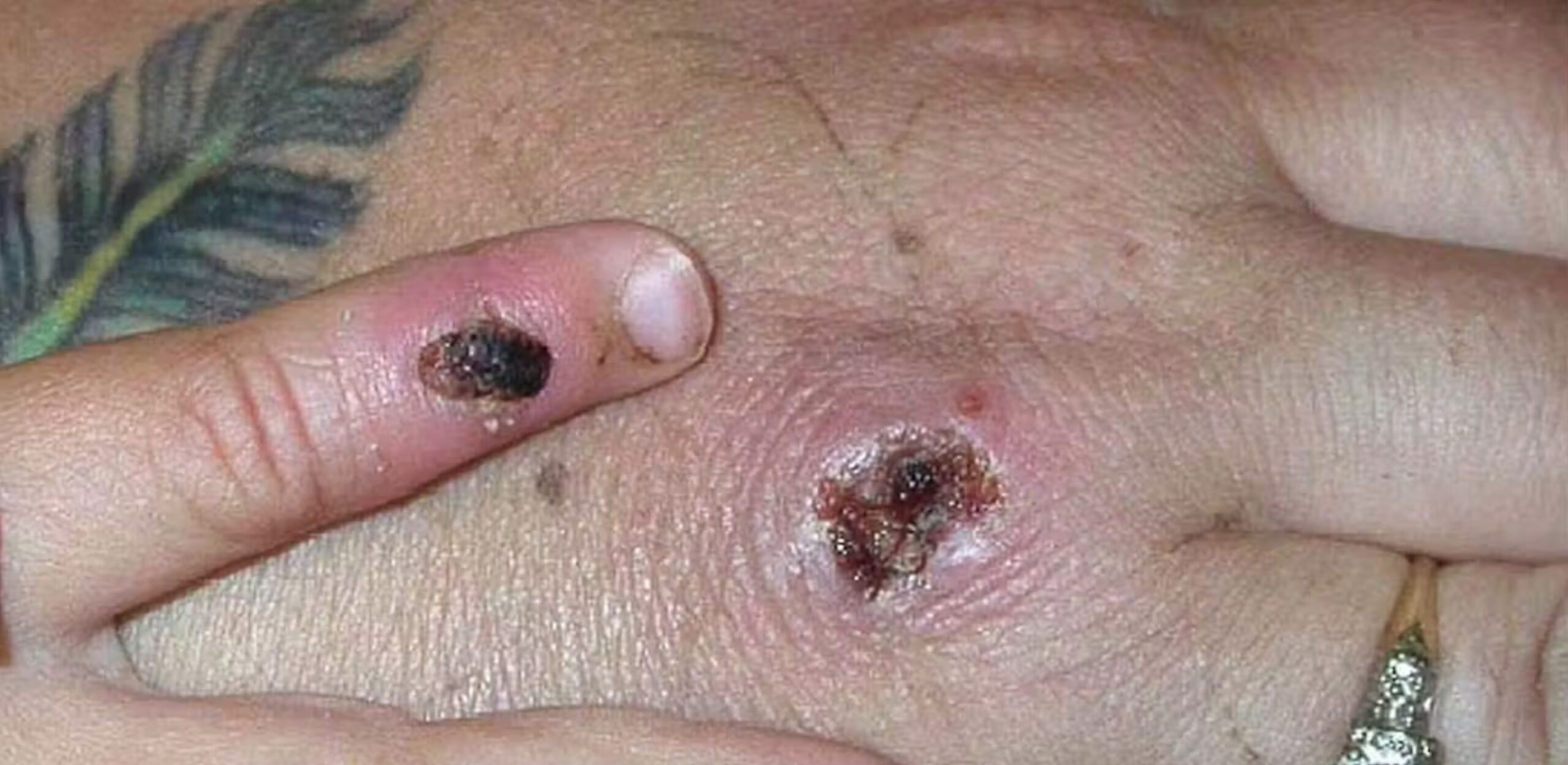 Mpox causes lesions that resemble pus-filled blisters, which eventually scab over. 