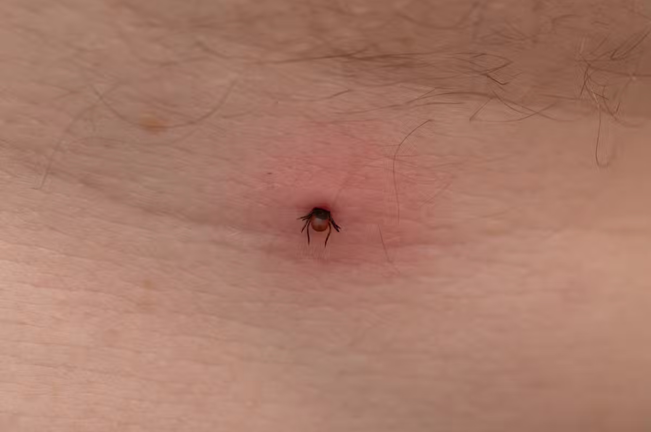 Many people don’t realise they’ve been bitten by a tick. 