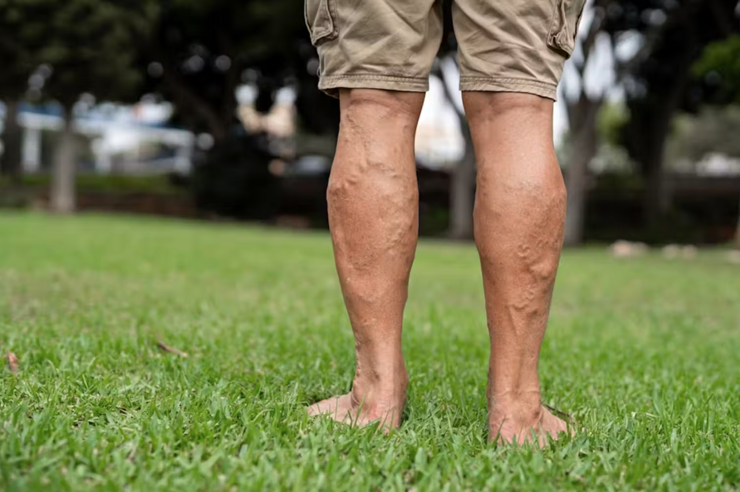 Standing for long periods can increase the risk of varicose veins. 